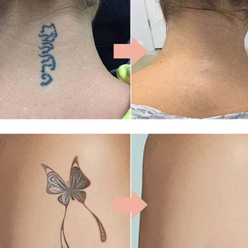 🏆 Last Day Special Price £9.99 ! 🔥Buy 2 Get 1 Free🎁 Gentle Effective Multi-Use Tattoo Fading Cream